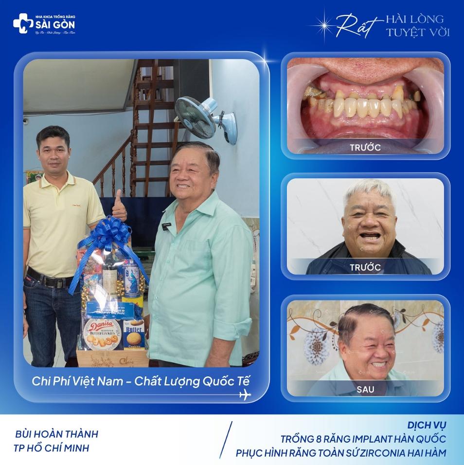 Trồng răng Implant