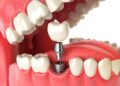 Người mất răng lâu năm nên trồng răng implant