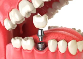 Người mất răng lâu năm nên trồng răng implant
