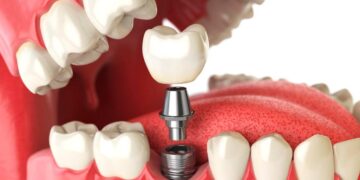 Người mất răng lâu năm nên trồng răng implant