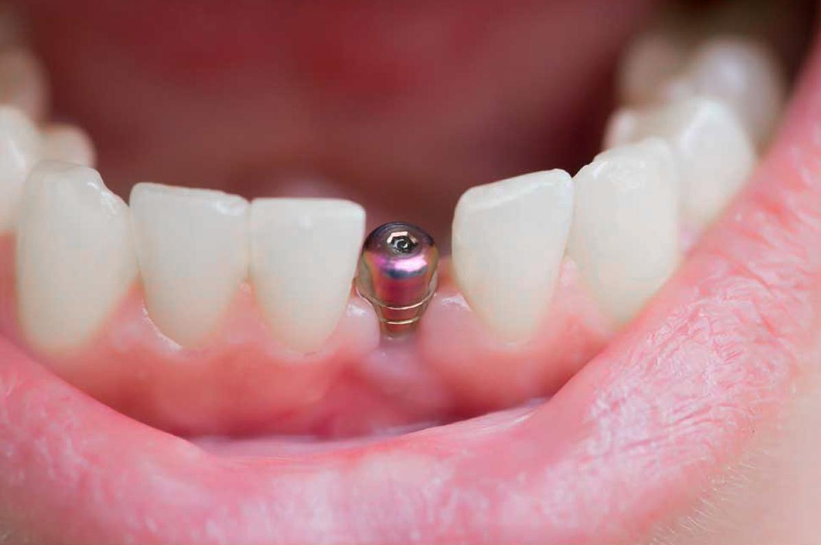 Nên cấy implant nếu mất một hoặc nhiều răng