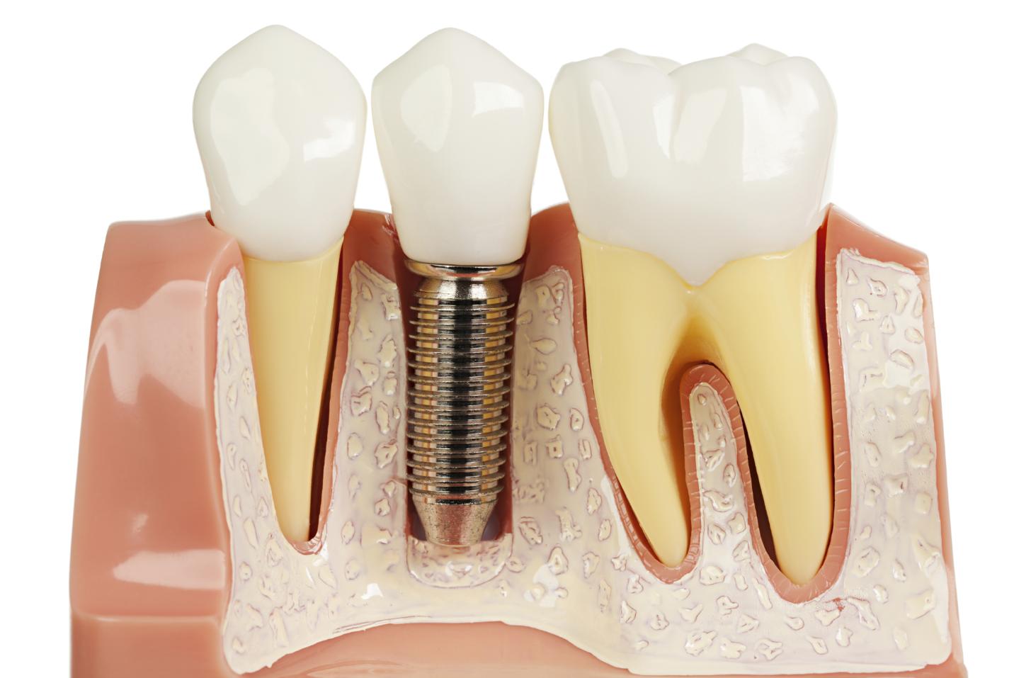 Răng Implant có độ bền tốt