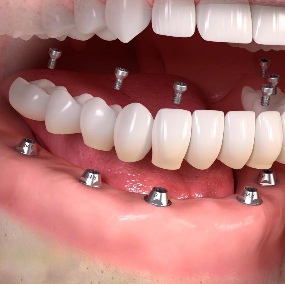 Khôi phục toàn bộ răng đã mất
